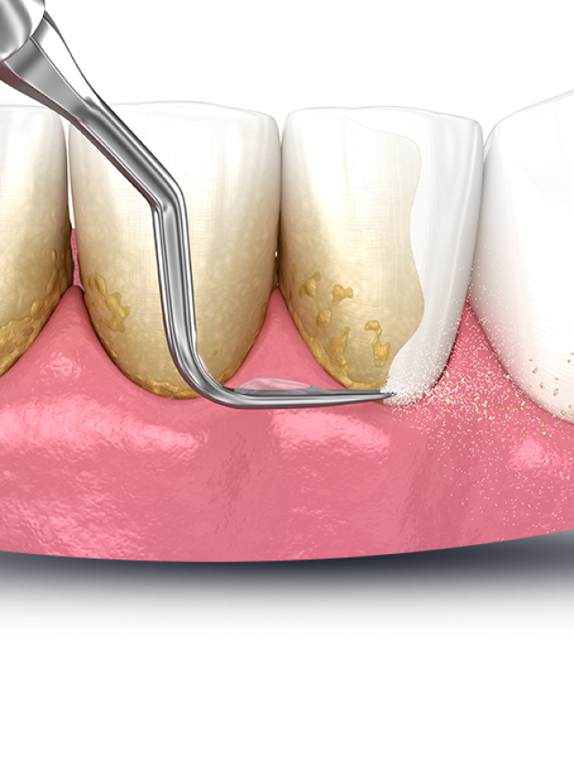 What are tooth scaling and root planing?