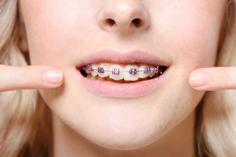 Orthodontics Mouth